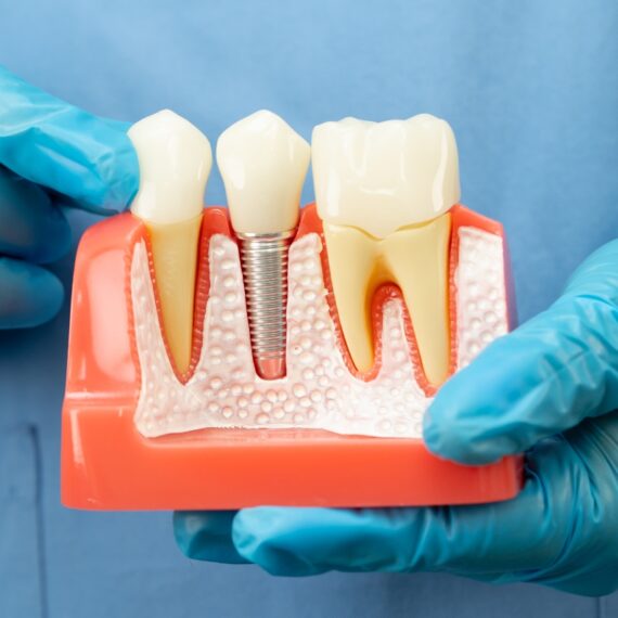 Cleaning and Caring for Your Dental Implants