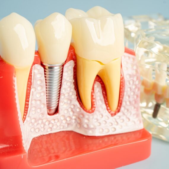 dental-implants-in-New-York
